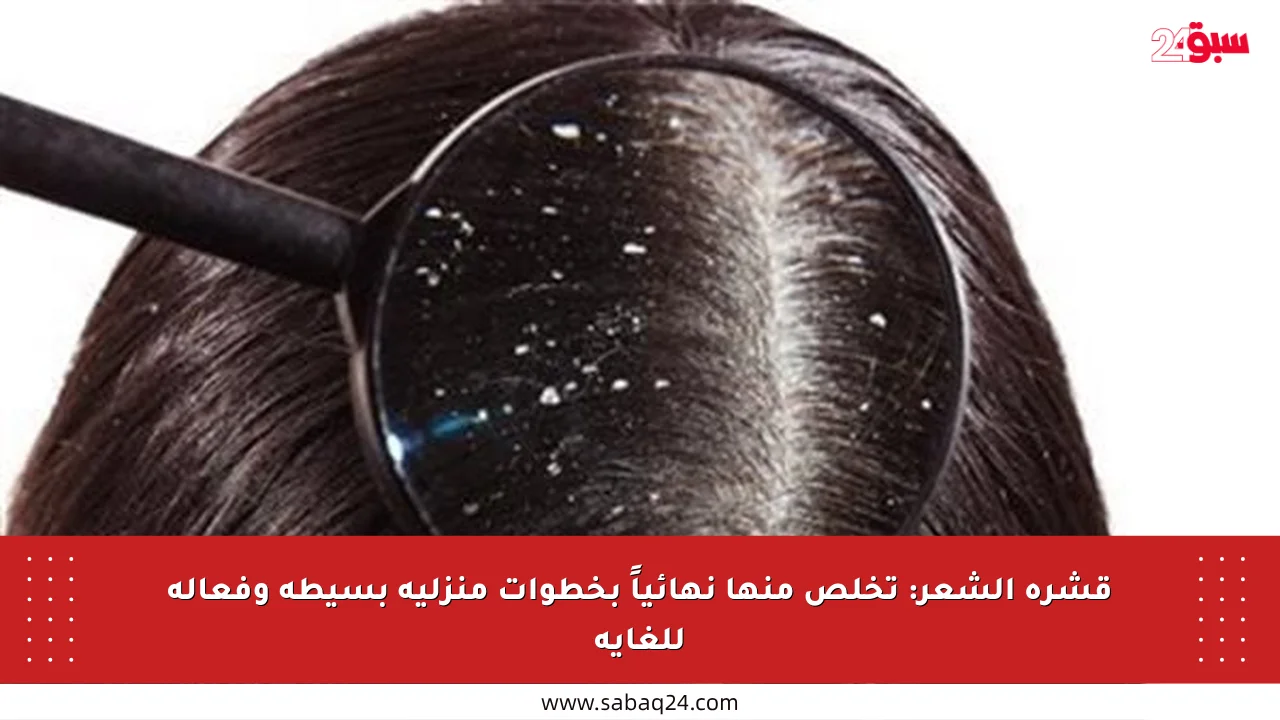 قشرة الشعر: تخلص منها نهائياً بخطوات منزلية بسيطة وفعالة للغاية